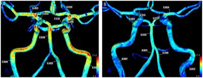 Cerebral artery signal intensity gradient from Time-of-Flight Magnetic Resonance Angiography and clinical outcome in lenticulostriate infarction: a retrospective cohort study